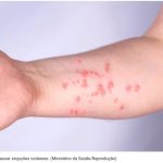 Brasil registra 88 casos de Mpox em 2026; saiba como evitar a doença