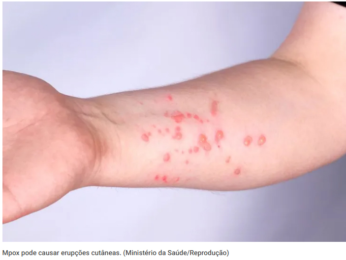 Brasil registra 88 casos de Mpox em 2026; saiba como evitar a doença